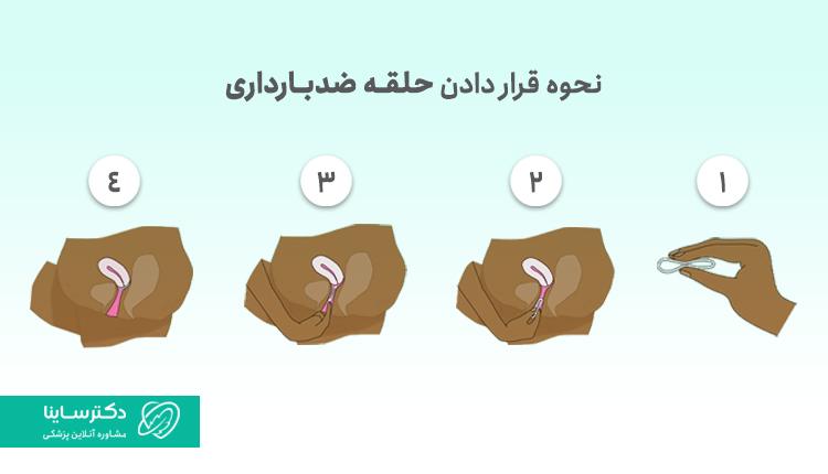 نحوه قرار دادن حلقه ضدبارداری