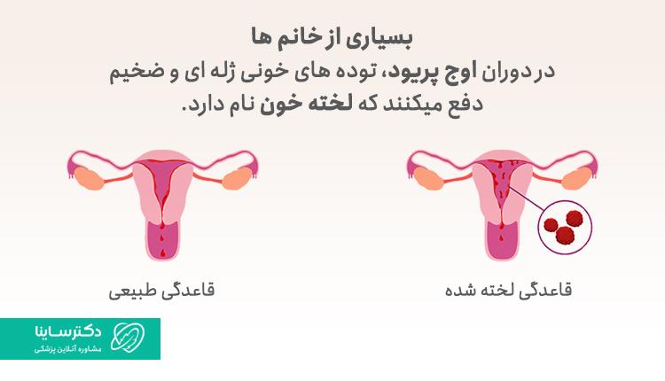 بسیاری از خانمها در دوران پریود، تودههای خونی ژلهای دفع میکنند.