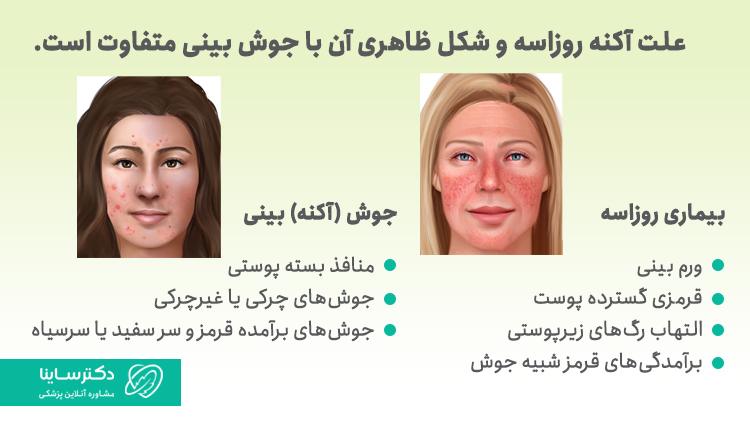 تفات چوش روی بینی و آکنه روزاسه