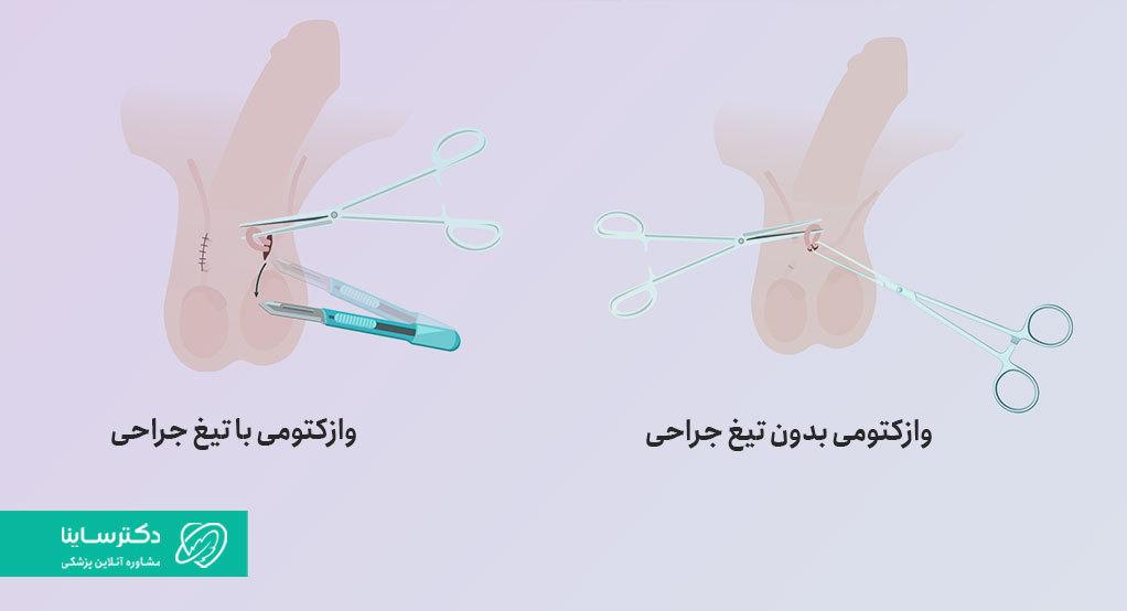 روشهای انجام وازکتومی