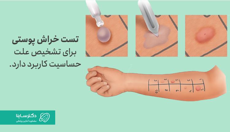 تست خراش پوستی برای تشخیص علت حساسیت کاربرد دارد.