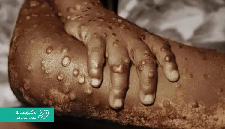 شکل بثورات پوستی و تاولهای آبله میمونی.