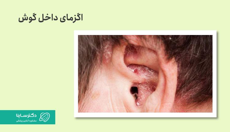 اگزمای داخل گوش