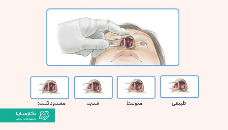 پولیپ بینی میتواند در اندازههای مختلف باشد.