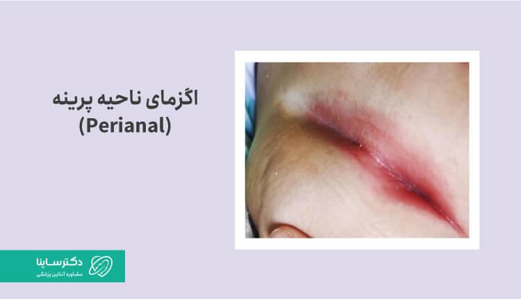 عگس اگزمای ناحیه پرینه 