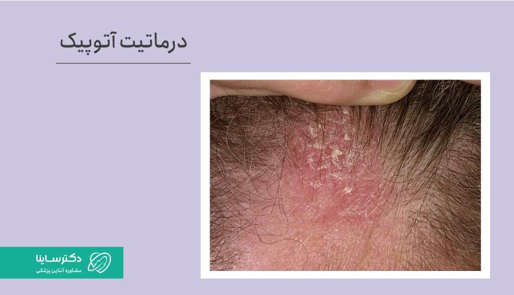 درماتیت آتوپیک یکی از انواع اگزمای پوست سر است.