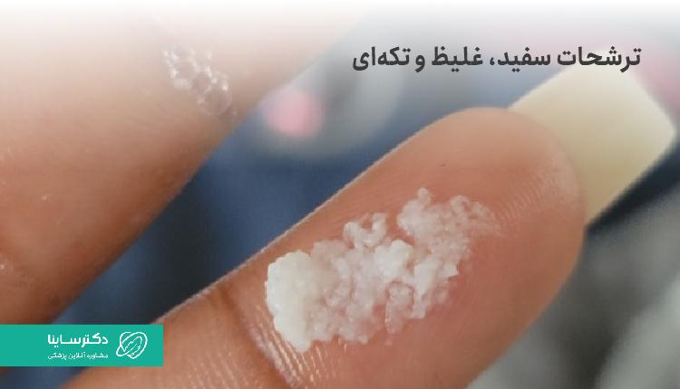 ترشحات پنیری و تکهای واژن، نشانه عفونت قارچی است.