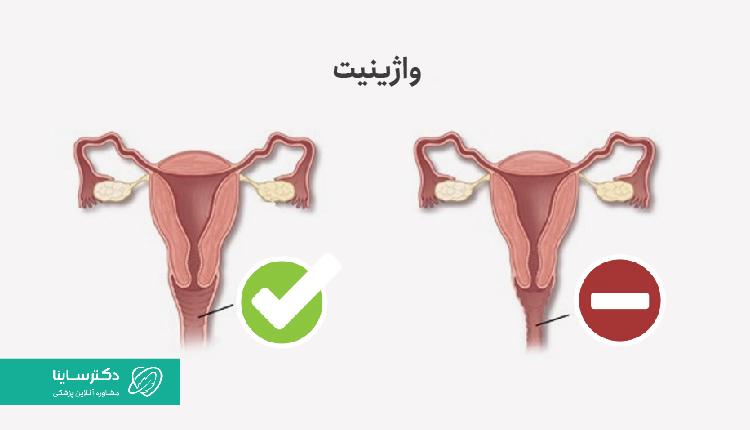 یکی از دلایل ترشحات زرد واژن، واژینیت است.