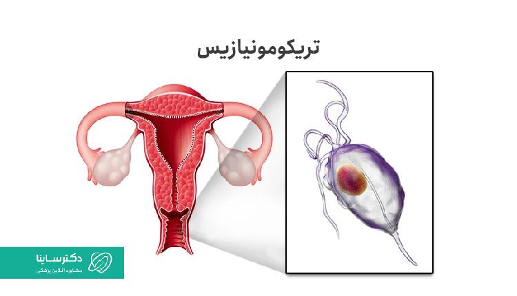 از علل ترشحات زرد واژن، تریکومونیازیس است.