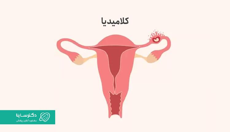 کلامیدیا، باعث ترشح زرد و بوی بد واژن میشود.