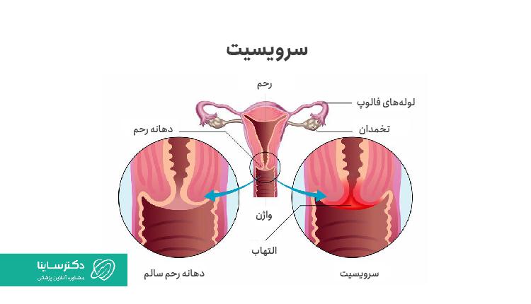 تفاوت دهانه رحم سالم و سرویسیت