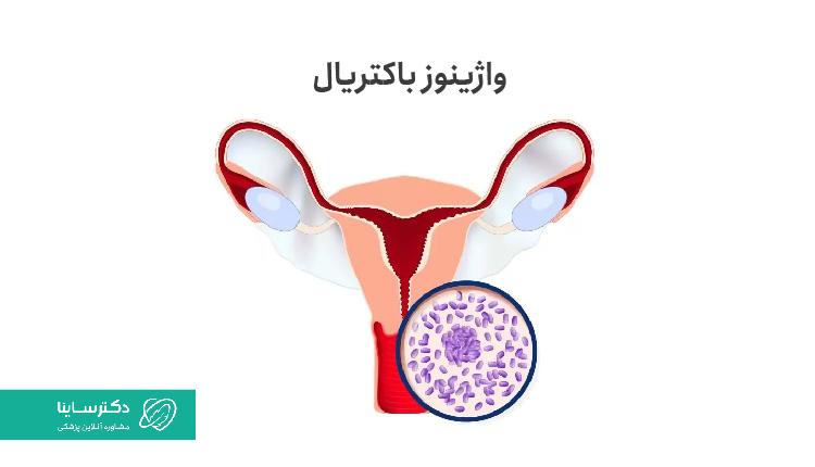 واژینوز باکتریال، نوعی عفونت واژن بوده که موجب عفونت زرد واژن میشود.