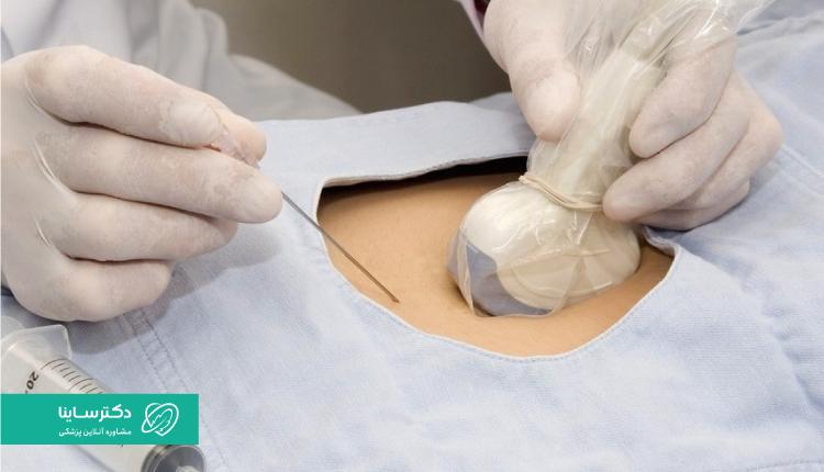 نمونه آزمایش آمنیوسنتز