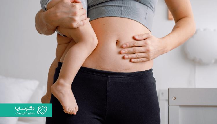 از مهمترین علل افتادگی شکم بعد از سزارین، فرآیند بارداری و زایمان است.