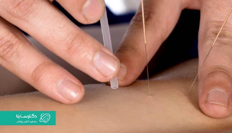در برخی موارد، طب سوزنی برای درمان زگیل تناسلی موثر است.