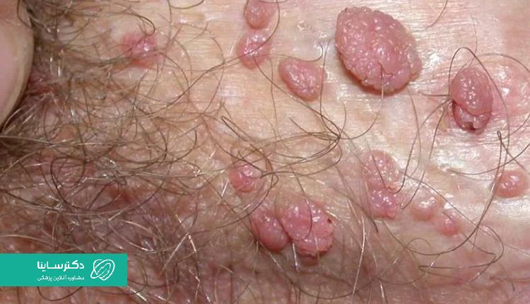 یکی از روشهای مطمئن برای درمان زگیل تناسلی، لیز است.