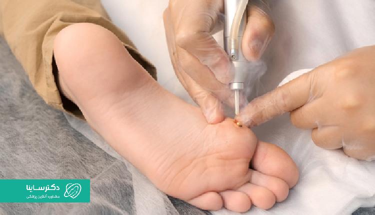 کرایوتراپی زگیل تناسلی نسبتا دردناک است.