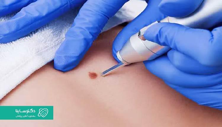 یکی از روشهای درمان زگیل تناسلی، الکتروکوتر است.