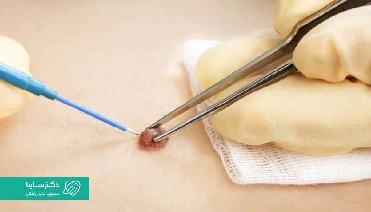 جراحی زگیل تناسلی روشی کاملا تهاجمی است.