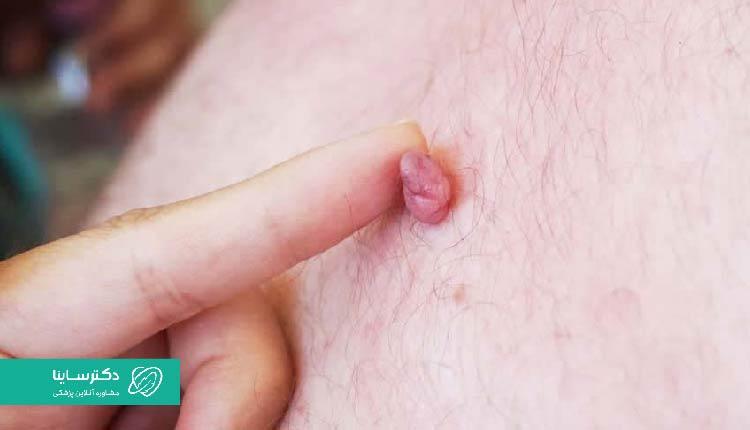به هیچوجه زگیل تناسلی را با نخ نکنید!