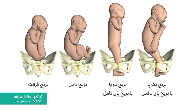 انواع زایمان بریچ