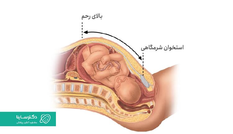 قرارگیری جنین در زایمان ماکروزمی