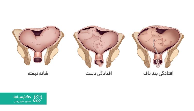 انواع زایمان عرضی