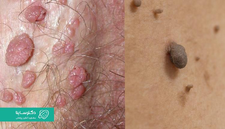 مقایسه زگیل تناسلی (تصویر سمت چپ) و خال گوشتی(تصویر سمت راست)