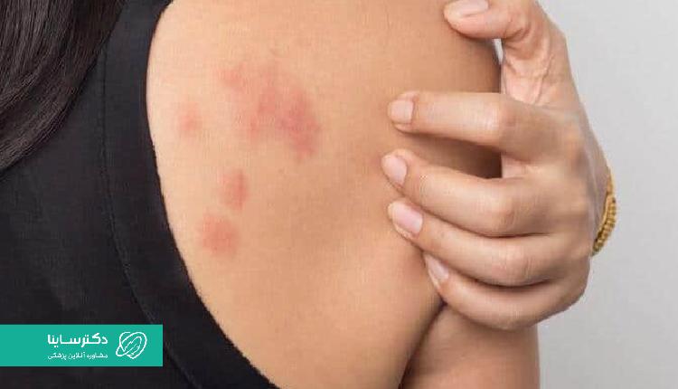 از عوارض کلوتریمازول، کهیر و خارش پوست است.
