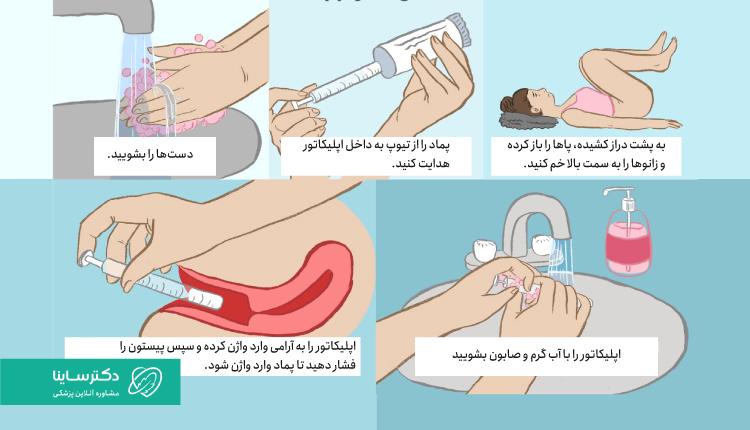 راهنمای استفاده از پماد واژینال کلوتریمازول