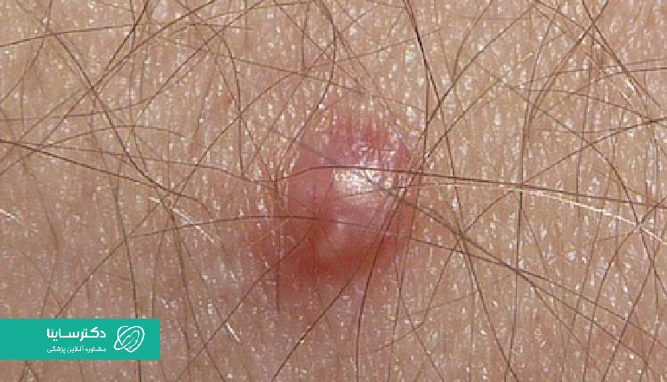 HPV میتواند باعث زگیل و در گاهی موارد حتی سرطان شود.