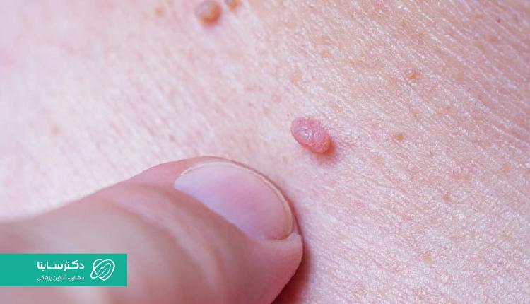 نمایی از گیل ناشی از ویروس HPV
