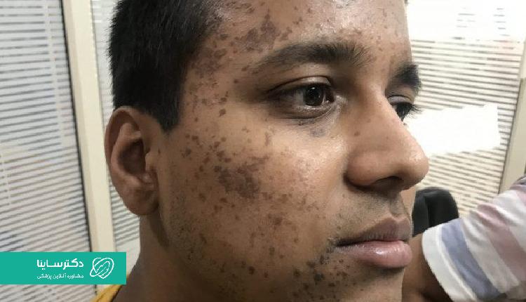 عکس زگیل مسطح بر روی صورت