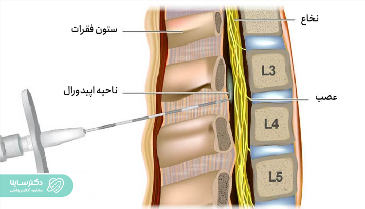 نحوه انجام تزریق برای زایمان اپیدورال.