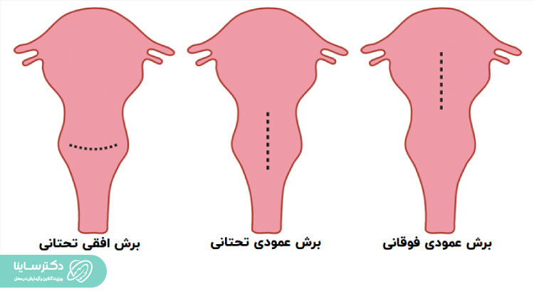 انواع برش در زایمان سزارین.