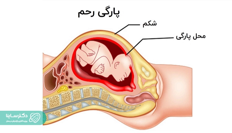 اگر خطر پارگی رحم بالا باشد نباید زایمان طبیعی بعد از سزارین را انجام داد.