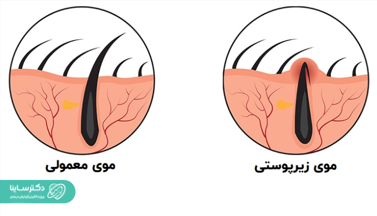 تفاوت موی معمولی و موی زیرپوستی.