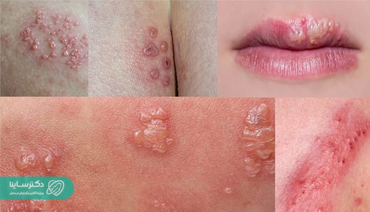 عمس تبخال تناسلی زنان و ناحیه مختلف.