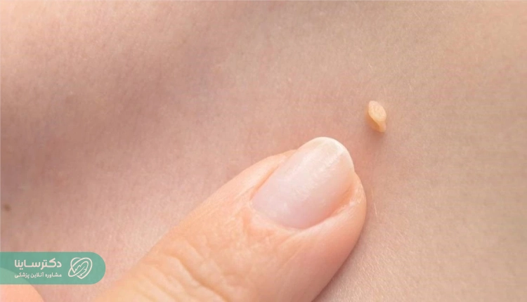 مادران بیمار به ویروس Hpv نباید زایمان فیزیولوژیک انجام دهند.