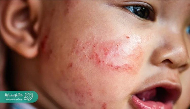 اگزما روی صورت کودک.