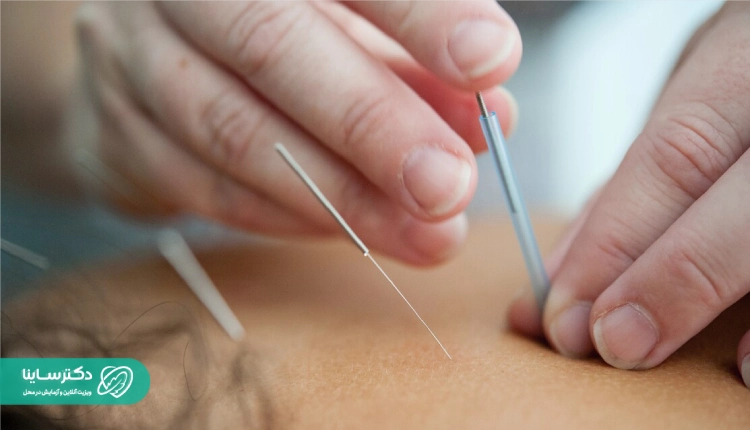 طب سوزنی برای تسکین علائم یائسگی