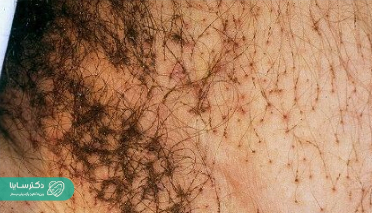 شکل ظاهری شپش تناسلی