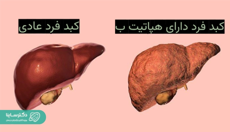 هپاتیت ب