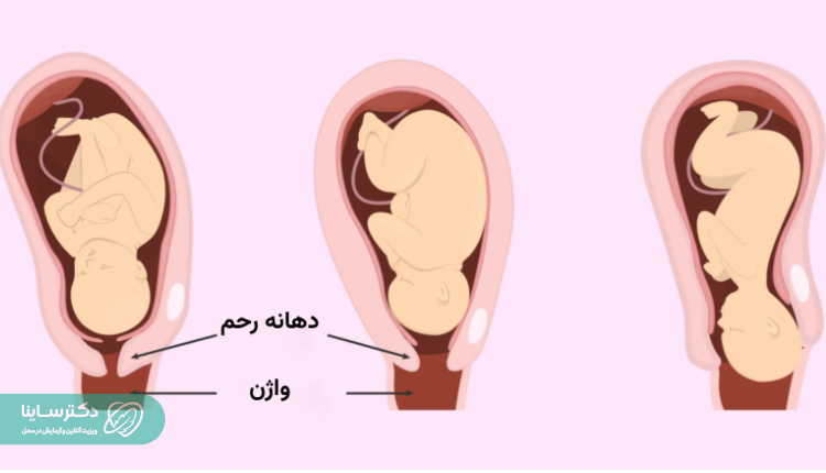 وضعیت خروج جفت در زایمان طبیعی.