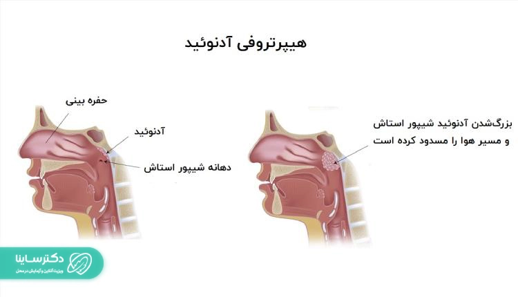هیپرتروفی آدنوئید در کودکان