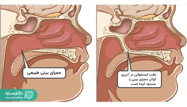 علائم شایع آترزی کوآن در کودکان