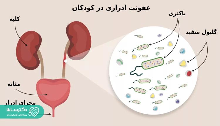عفونت ادراری کودکان
