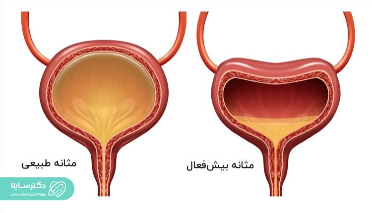 مثانه بیش فعال ار علت های بی اختیاری ادرار در کودکان