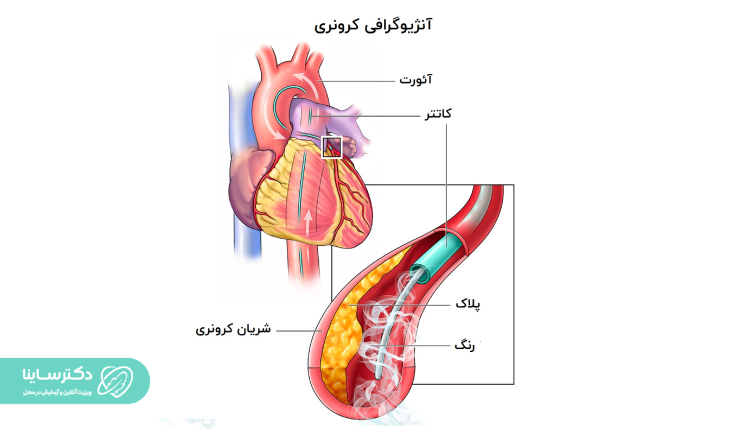 آنژیوگرافی کرونری چیست