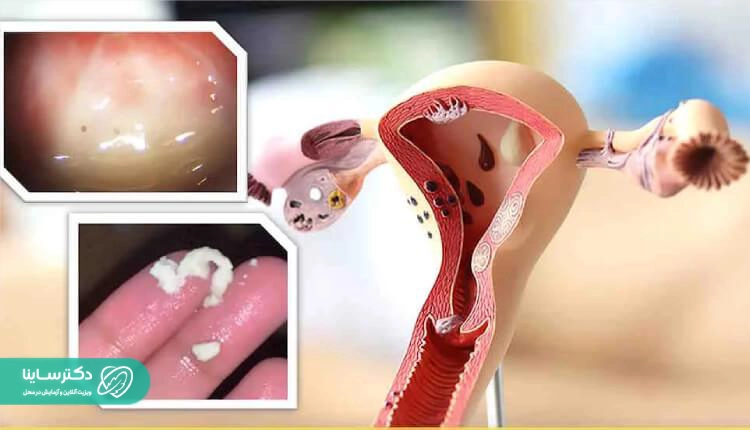 واژینوز باکتریال از طریق رابطه جنسی منتقل نمیشود